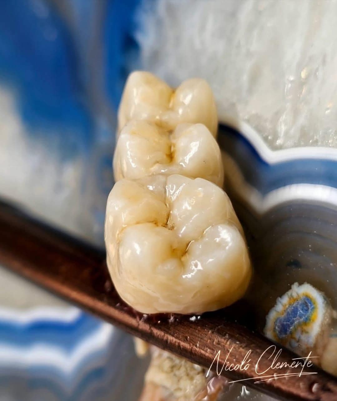 Corone posteriori in ceramica caratterizzate a mano